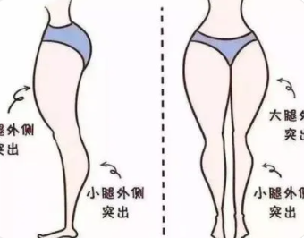 肌肉大腿怎么瘦下来变成筷子腿