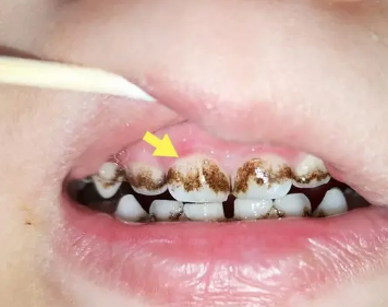 幼儿牙齿不好的图片图片