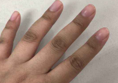 手指关节发黑是什么原因1