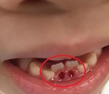小孩子一到五六岁的时候就开始换牙了,乳牙掉了之后就会长出恒牙,恒牙