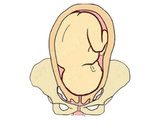臀位分娩难产图片图片