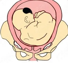 10个月胎位图3