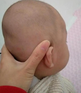 婴儿后脑勺有凸起图片图片