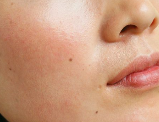 没有疾病,可能是由于环境比较干燥,或者是不注意脸部皮肤的护肤滋润